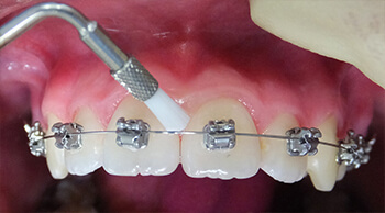 虫歯・歯周病の予防と矯正治療